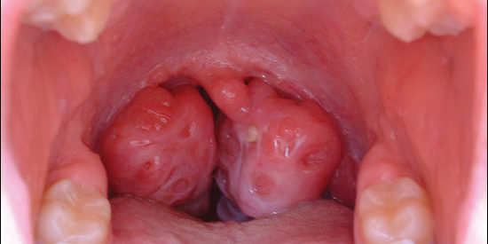 Bademcik Büyümesi Bademcik Büyümesi