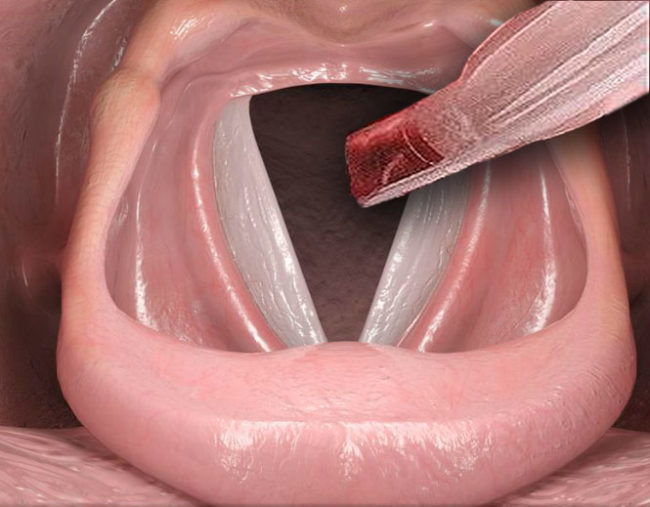 Mikroskopik Ses Teli Ameliyatı