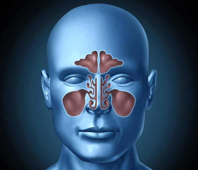 Sinüzit Nedir? Belirtileri Nelerdir? Nasıl Tedavi Edilir?