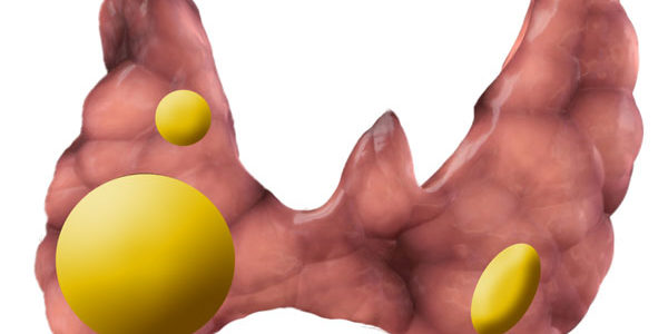 Tiroidektomi Tiroidektomi