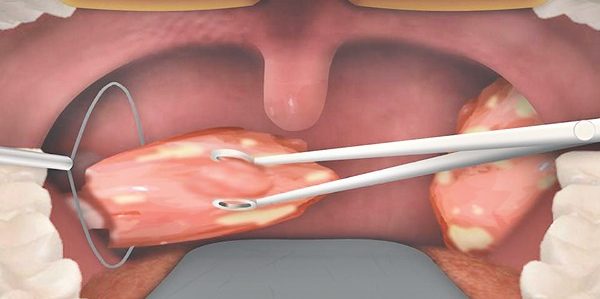 Bademcik Ameliyatı (Tonsillektomi)