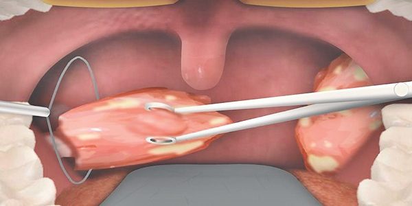 Bademcik Ameliyatı (Tonsillektomi)