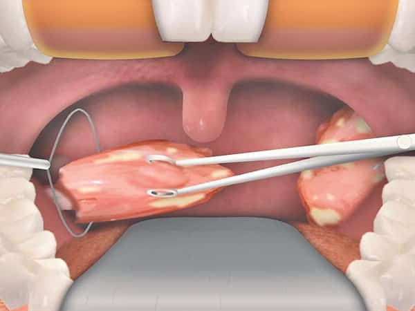 Bademcik Ameliyatı (Tonsillektomi)