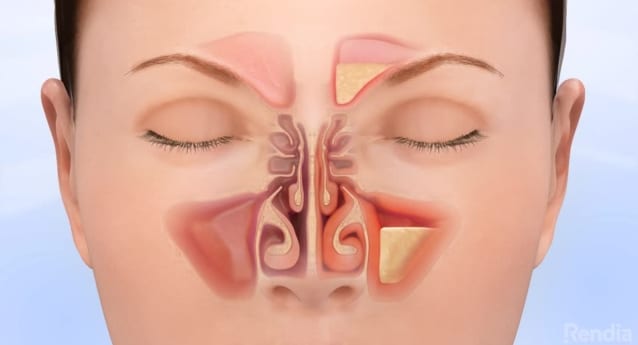 Burun Hastalıkları (Rinoloji) Burun Hastalıkları (Rinoloji)