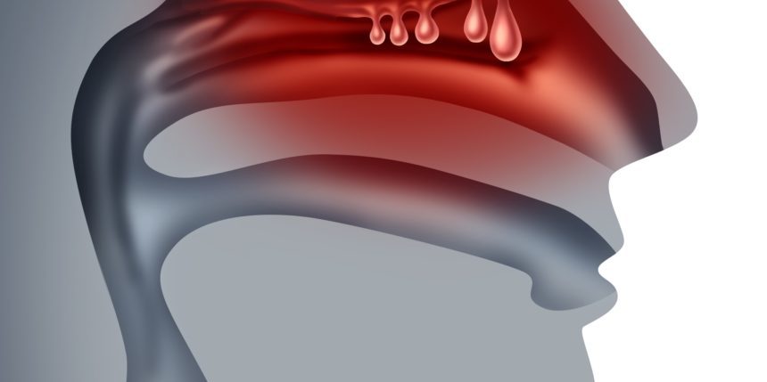 Burun Polibi (Nazal Polip)