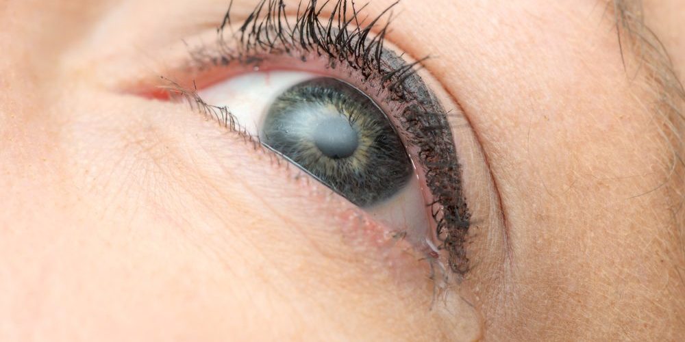 Endoskopik Gözyaşı Kesesi Ameliyatı