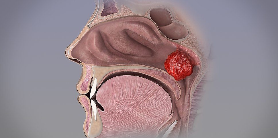 Geniz Eti Büyümesi