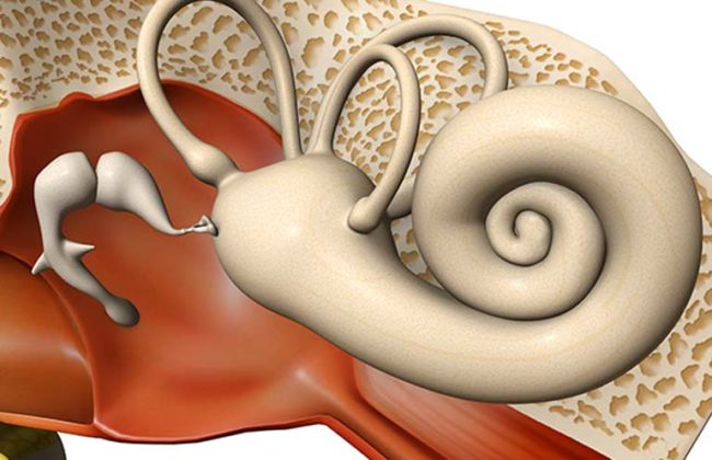 Kulak Kireçlenmesi (Otosleroz) Kulak Kireçlenmesi (Otosleroz)