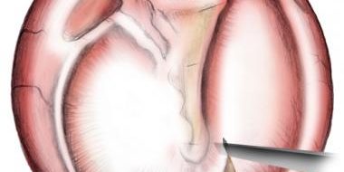 Kulak Zarı Çizilmesi (Miringotomi)