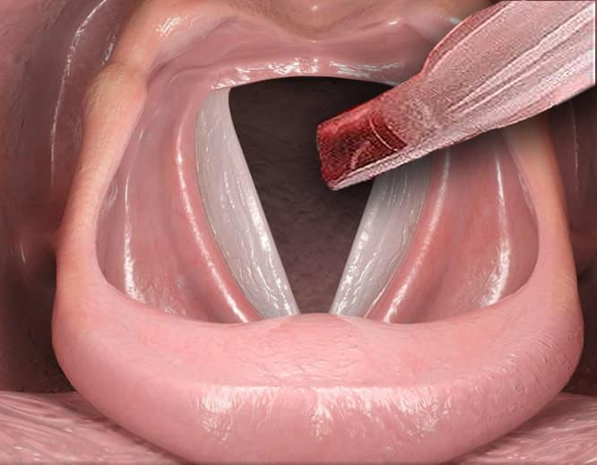 Mikroskopik Ses Teli Ameliyatı Mikroskopik Ses Teli Ameliyatı