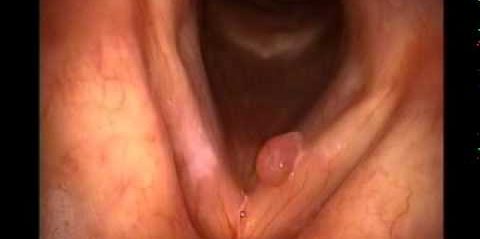 Ses Teli Polip, Nodül ve Kisti