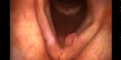 Ses Teli Polip, Nodül ve Kisti