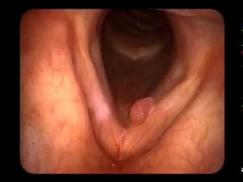 Ses Teli Polip, Nodül ve Kisti