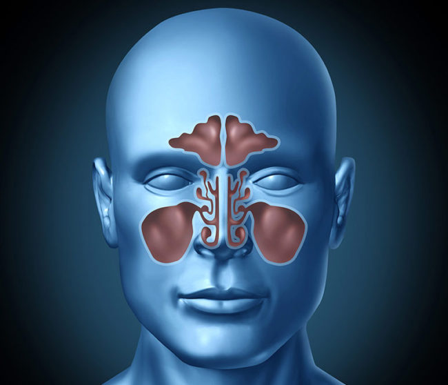 Sinüzit Nedir? Belirtileri Nelerdir? Nasıl Tedavi Edilir?